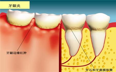 牙龈出血究竟怎么回事？原来是这3种病！